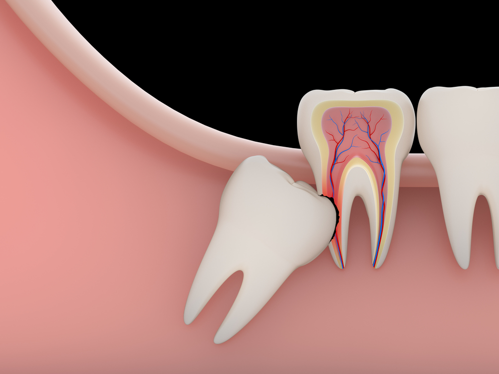 Frequently Asked Questions About Wisdom Teeth Removal
