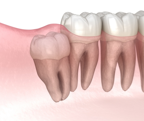Frequently Asked Questions About Wisdom Teeth Removal Part 2