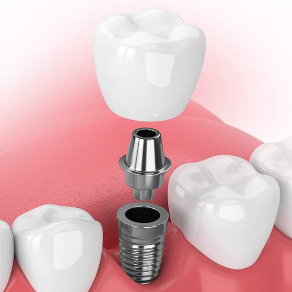 Am I a Candidate for Dental Implants?